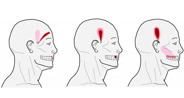 points d'acupression